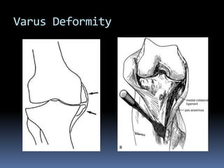 Total knee arthroplasty by dr..ammar m.sheet | PPSX
