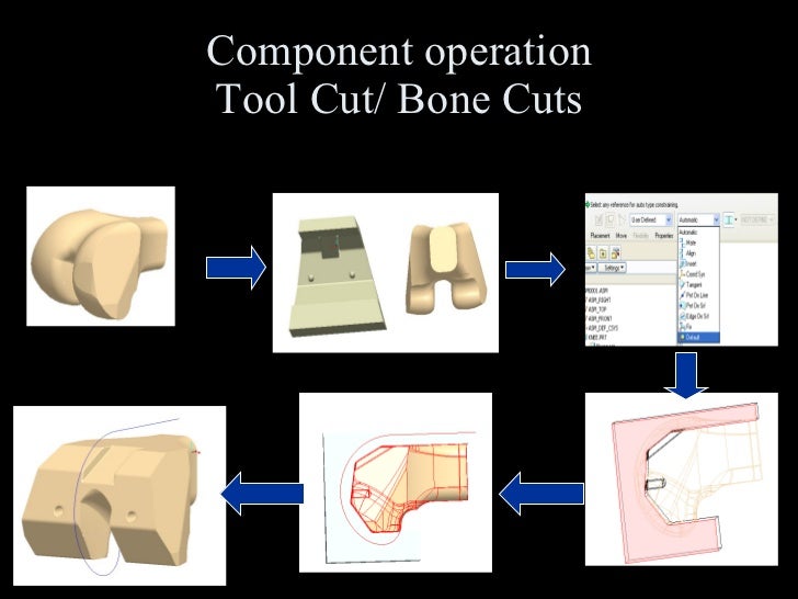 Total Knee Replacement