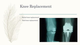 Knee Replacement
– Partial knee replacement
– Total knee replacement
 