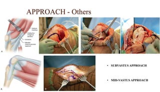 APPROACH - Others
• SUBVASTUS APPROACH
• MID-VASTUS APPROACH
 