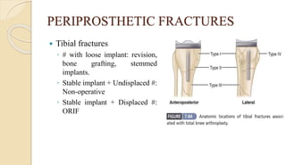 PERIPROSTHETIC FRACTURES
 Tibial fractures
◦ # with loose implant: revision,
bone grafting, stemmed
implants.
◦ Stable implant + Undisplaced #:
Non-operative
◦ Stable implant + Displaced #:
ORIF
 
