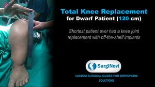 CUSTOM SURGICAL GUIDES FOR ORTHOPEDIC
SOLUTIONS
Total Knee Replacement
for Dwarf Patient (120 cm)
Shortest patient ever had a knee joint
replacement with off-the-shelf implants
 