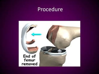 Procedure
 