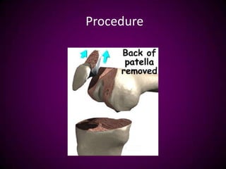 Procedure
 