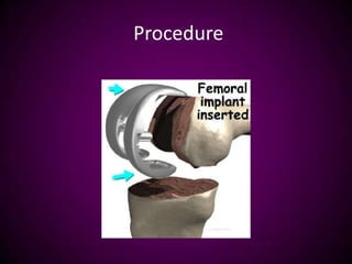 Procedure
 