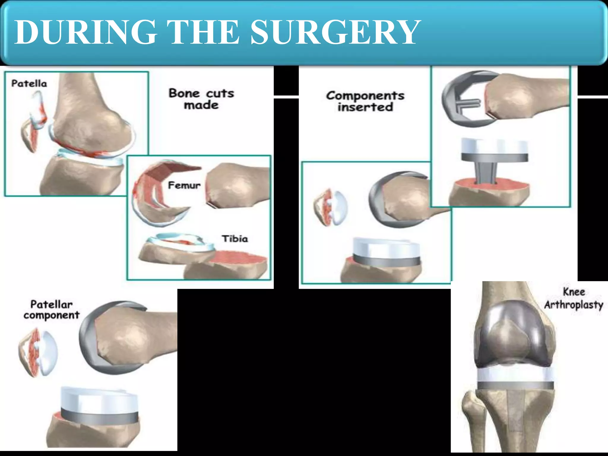 Total knee replacement patient education | PPTX