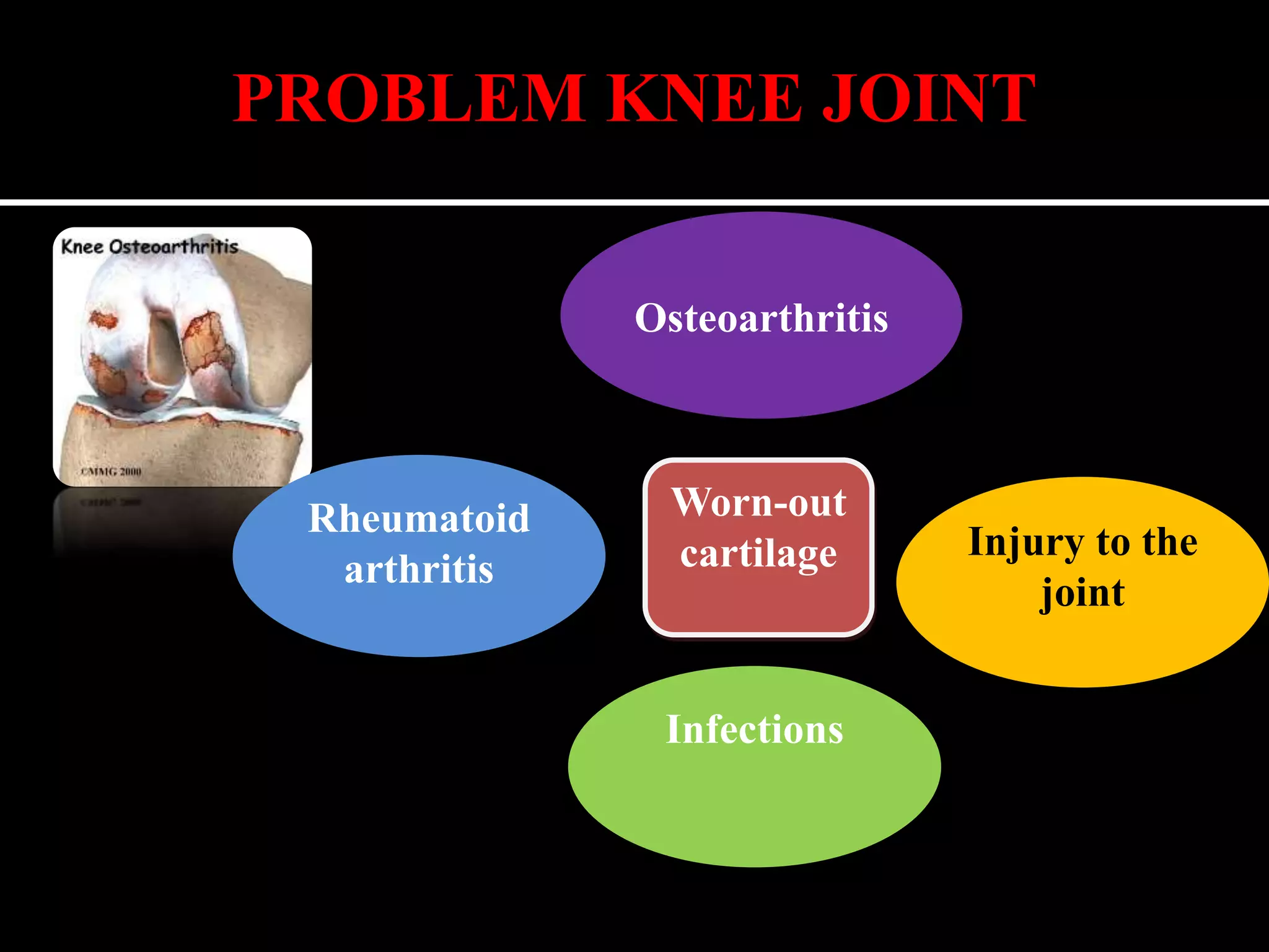 Total knee replacement patient education | PPTX