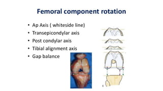 TOTAL KNEE replacement TKR arthroplasty TKA Presenter.pptx