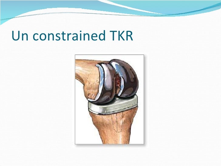Total knee replacement (tkr) ppt