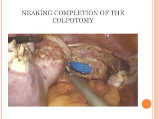Total Laparoscopic Hysterectomy- Tips, Tricks & Techniques | PPT
