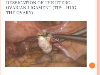 THE VESICOUTERINE PERITONEAL
FOLD
(UV FOLD)
TIP:- LIFT THE BLADDER NICELY
 