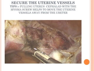 SEPARATE THE UTERUS AND CERVIX
FROM THE VAGINAL APEX
TIP : DONT TOUCH THE HARMONIC SCALPEL DIRECTLY INTO
THE METAL OR CCL ...