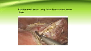 TOTAL LAPROSCOPIC HYSTERECTOMY PROCEDURE | PPT