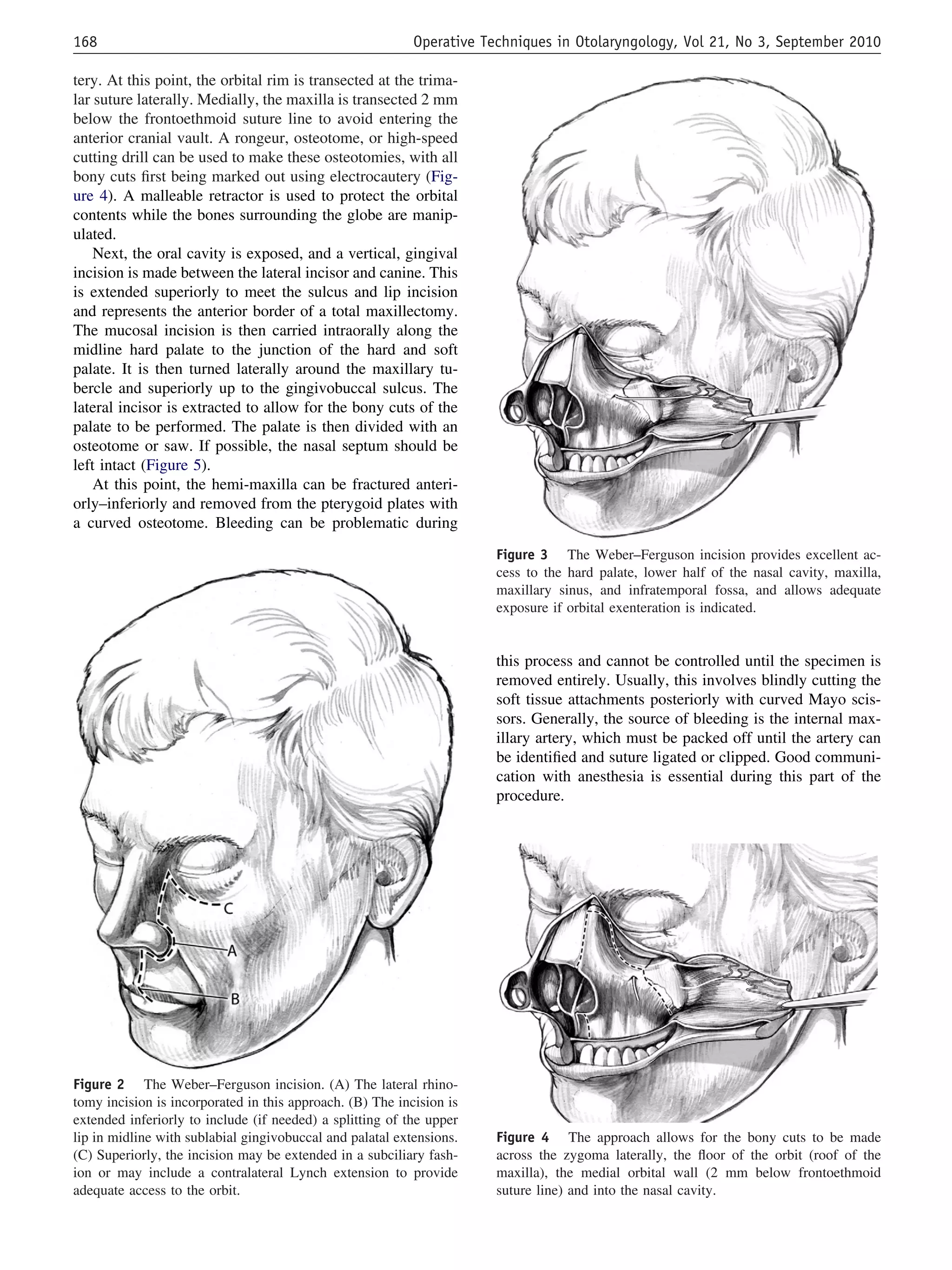 tery. At this point, the orbital rim is transected at the trima-
lar suture laterally. Medially, the maxilla is transected 2 mm
below the frontoethmoid suture line to avoid entering the
anterior cranial vault. A rongeur, osteotome, or high-speed
cutting drill can be used to make these osteotomies, with all
bony cuts ﬁrst being marked out using electrocautery (Fig-
ure 4). A malleable retractor is used to protect the orbital
contents while the bones surrounding the globe are manip-
ulated.
Next, the oral cavity is exposed, and a vertical, gingival
incision is made between the lateral incisor and canine. This
is extended superiorly to meet the sulcus and lip incision
and represents the anterior border of a total maxillectomy.
The mucosal incision is then carried intraorally along the
midline hard palate to the junction of the hard and soft
palate. It is then turned laterally around the maxillary tu-
bercle and superiorly up to the gingivobuccal sulcus. The
lateral incisor is extracted to allow for the bony cuts of the
palate to be performed. The palate is then divided with an
osteotome or saw. If possible, the nasal septum should be
left intact (Figure 5).
At this point, the hemi-maxilla can be fractured anteri-
orly–inferiorly and removed from the pterygoid plates with
a curved osteotome. Bleeding can be problematic during
this process and cannot be controlled until the specimen is
removed entirely. Usually, this involves blindly cutting the
soft tissue attachments posteriorly with curved Mayo scis-
sors. Generally, the source of bleeding is the internal max-
illary artery, which must be packed off until the artery can
be identiﬁed and suture ligated or clipped. Good communi-
cation with anesthesia is essential during this part of the
procedure.
Figure 4 The approach allows for the bony cuts to be made
across the zygoma laterally, the ﬂoor of the orbit (roof of the
maxilla), the medial orbital wall (2 mm below frontoethmoid
suture line) and into the nasal cavity.
Figure 2 The Weber–Ferguson incision. (A) The lateral rhino-
tomy incision is incorporated in this approach. (B) The incision is
extended inferiorly to include (if needed) a splitting of the upper
lip in midline with sublabial gingivobuccal and palatal extensions.
(C) Superiorly, the incision may be extended in a subciliary fash-
ion or may include a contralateral Lynch extension to provide
adequate access to the orbit.
Figure 3 The Weber–Ferguson incision provides excellent ac-
cess to the hard palate, lower half of the nasal cavity, maxilla,
maxillary sinus, and infratemporal fossa, and allows adequate
exposure if orbital exenteration is indicated.
168 Operative Techniques in Otolaryngology, Vol 21, No 3, September 2010
 