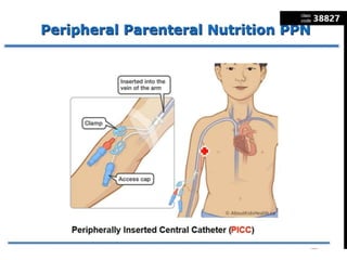 Peripheral Parenteral Nutrition