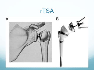 Tsa Rts A Total shoulder arthroplasty and reverse TSA - Hussain Algawahmed | PPTX