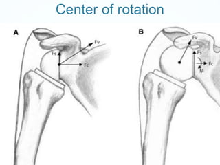 Total shoulder arthroplasty and reverse TSA - Hussain Algawahmed | PPTX