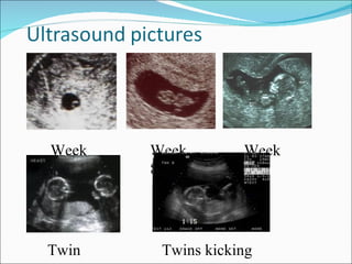 Week   Week        Week
5      8           11




Twin    Twins kicking
 
