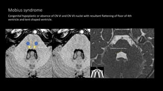 Mobius syndrome
Congenital hypoplastic or absence of CN VI and CN VII nuclei with resultant flattening of floor of 4th
ventricle and tent-shaped ventricle.
 