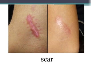 scar
 