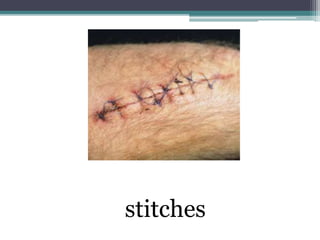stitches
 