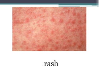 rash
 
