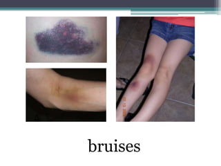 bruises
 