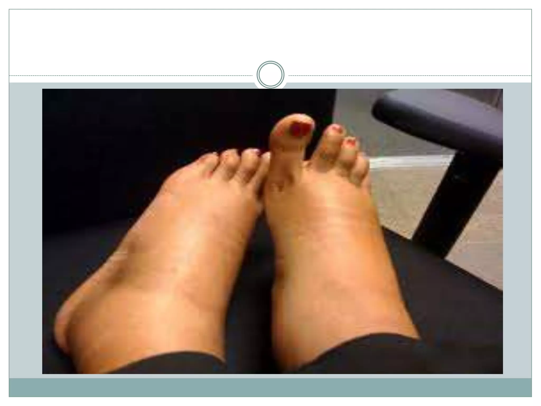 Toxemia in-pregnancy