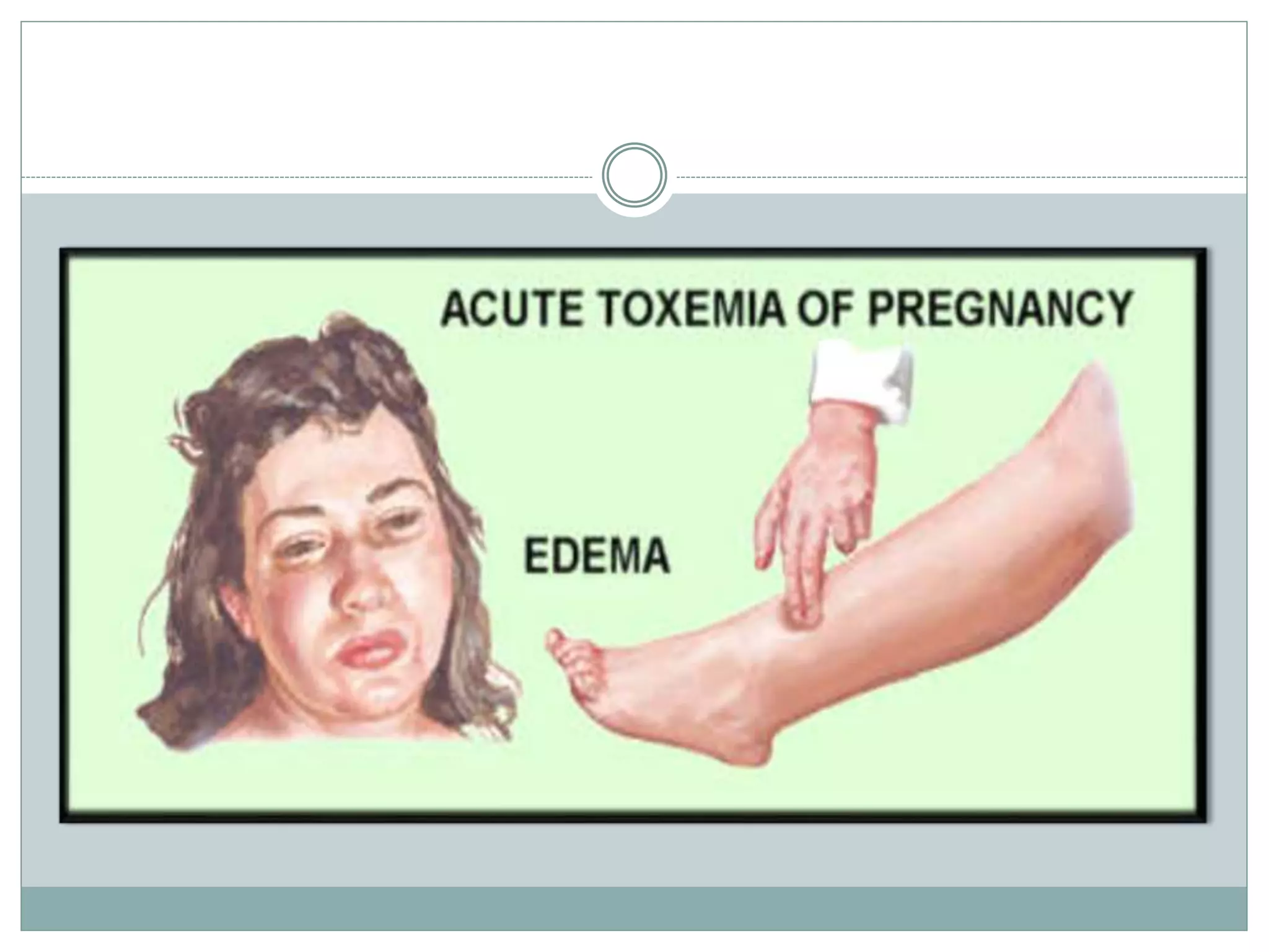 Toxemia in-pregnancy