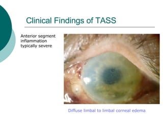 Clinical Findings of TASS Anterior segment inflammation typically severe Diffuse limbal to limbal corneal edema  