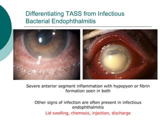 Differentiating TASS from Infectious Bacterial Endophthalmitis Severe anterior segment inflammation with hypopyon or fibrin formation seen in both Other signs of infection are often present in infectious endophthalmitis Lid swelling, chemosis, injection, discharge 