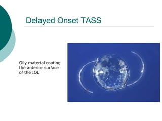 Delayed Onset TASS Oily material coating the anterior surface of the IOL 