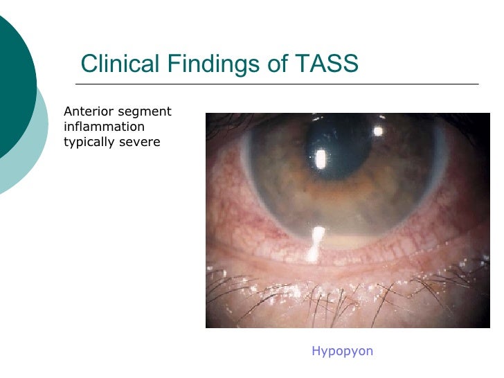 Toxic Anterior Segment Syndrome