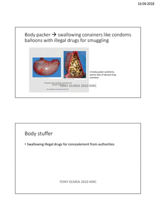 16-04-2018
Body packer  swallowing conainers like condoms
balloons with illegal drugs for smuggling
In body packer syndrome,
person dies of abused drug
overdose
TONY SCARIA 2010 KMC
Body stuffer
• Swallowing illegal drugs for concealement from authorities
TONY SCARIA 2010 KMC
 