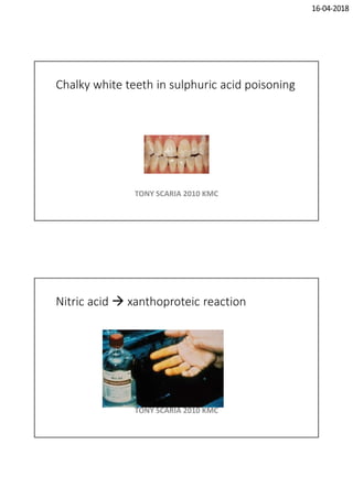 16-04-2018
Chalky white teeth in sulphuric acid poisoning
TONY SCARIA 2010 KMC
Nitric acid  xanthoproteic reaction
TONY SCARIA 2010 KMC
 