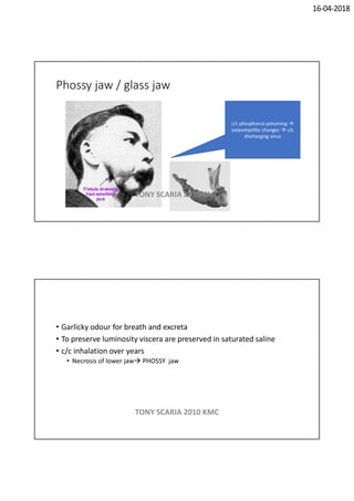 16-04-2018
Phossy jaw / glass jaw
c/c phosphorus poisoning 
osteomyelitic changes  c/c
discharging sinus
TONY SCARIA 2010 KMC
• Garlicky odour for breath and excreta
• To preserve luminosity viscera are preserved in saturated saline
• c/c inhalation over years
• Necrosis of lower jaw PHOSSY jaw
TONY SCARIA 2010 KMC
 