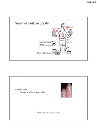 16-04-2018
Smell of garlic in breath
Mee’s lines after 6
weeks
TONY SCARIA 2010 KMC
• Mee’s lines
• Transverse white striae on nails
TONY SCARIA 2010 KMC
 
