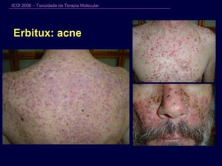 Erbitux: acne 
