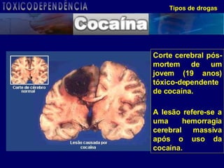 Tipos de drogas Corte cerebral pós-mortem de um jovem (19 anos) tóxico-dependente de cocaína. A lesão refere-se a uma hemorragia cerebral massiva após o uso da cocaína.   TOXICODEPENDÊNCIA 