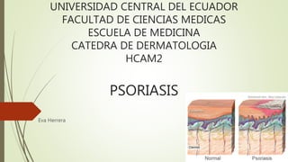 UNIVERSIDAD CENTRAL DEL ECUADOR
FACULTAD DE CIENCIAS MEDICAS
ESCUELA DE MEDICINA
CATEDRA DE DERMATOLOGIA
HCAM2
PSORIASIS
Eva Herrera
 