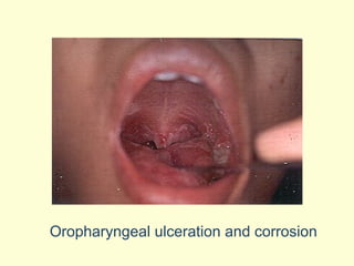Oropharyngeal ulceration and corrosion 