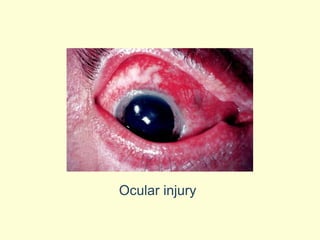 Ocular injury 