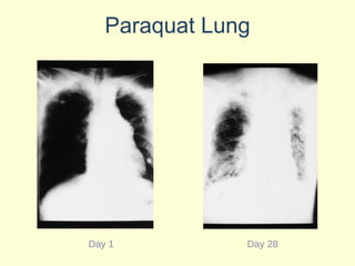 Paraquat Lung Day 1 Day 28 
