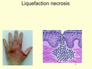Liquefaction necrosis 