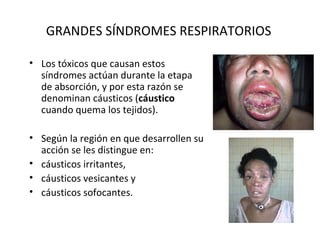GRANDES SÍNDROMES RESPIRATORIOS

• Los tóxicos que causan estos
  síndromes actúan durante la etapa
  de absorción, y por esta razón se
  denominan cáusticos (cáustico
  cuando quema los tejidos).

• Según la región en que desarrollen su
  acción se les distingue en:
• cáusticos irritantes,
• cáusticos vesicantes y
• cáusticos sofocantes.
 