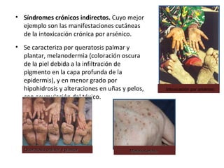 • Síndromes crónicos indirectos. Cuyo mejor
  ejemplo son las manifestaciones cutáneas
  de la intoxicación crónica por arsénico.
• Se caracteriza por queratosis palmar y
  plantar, melanodermia (coloración oscura
  de la piel debida a la infiltración de
  pigmento en la capa profunda de la
  epidermis), y en menor grado por
  hipohidrosis y alteraciones en uñas y pelos,          Intoxicación por arsénico
  con acumulación del tóxico.




   Queratosis palmar y plantar           Melanodermia
 