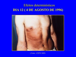 DIA 12 ( 4 DE AGOSTO DE 1996) Efeitos determinísticos ( Fonte - CDTN 2009) 
