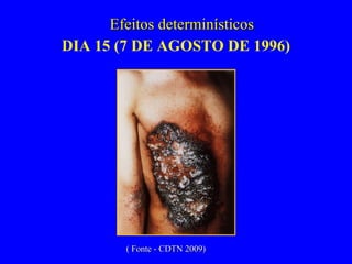 DIA 15 (7 DE AGOSTO DE 1996) Efeitos determinísticos ( Fonte - CDTN 2009) 