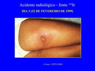 DIA 3 (22 DE FEVEREIRO DE 1999) Acidente radiológico - fonte  192 Ir  ( Fonte - CDTN 2009) 