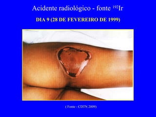 DIA 9 (28 DE FEVEREIRO DE 1999) Acidente radiológico - fonte  192 Ir  ( Fonte - CDTN 2009) 